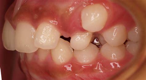 Concerns Surrounding the Outcome of Misplacing Masticating Teeth