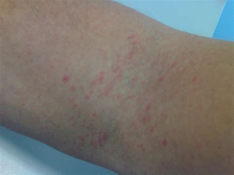 Contact Dermatitis: How Certain Substances Can Lead to Arm Rashes