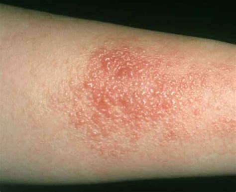 Contact Dermatitis: Irritating Substances and Allergens that Trigger Skin Rashes