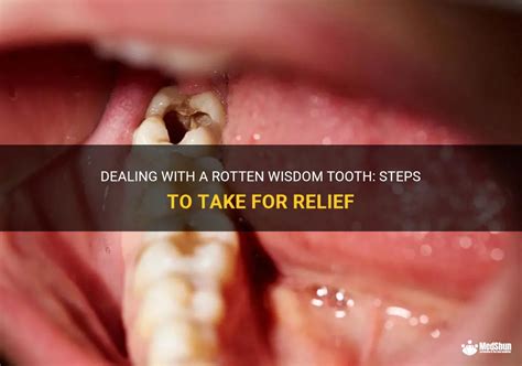 Coping Strategies and Solutions for Dealing with Dreams of Removing a Rotten Tooth