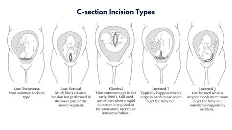 Coping Strategies for Dealing with Emotional Distress Caused by Scarring from Cesarean Delivery