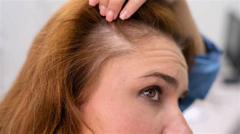 Cracking the Code: Shedding Light on the Science of Female Baldness