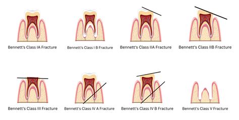 Cultural and Symbolic Interpretations of Dental Fractures