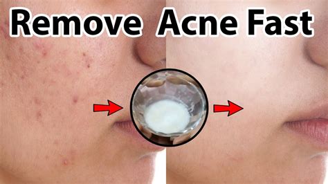 DIY Solutions to Try: Home Remedies for Acne Scars