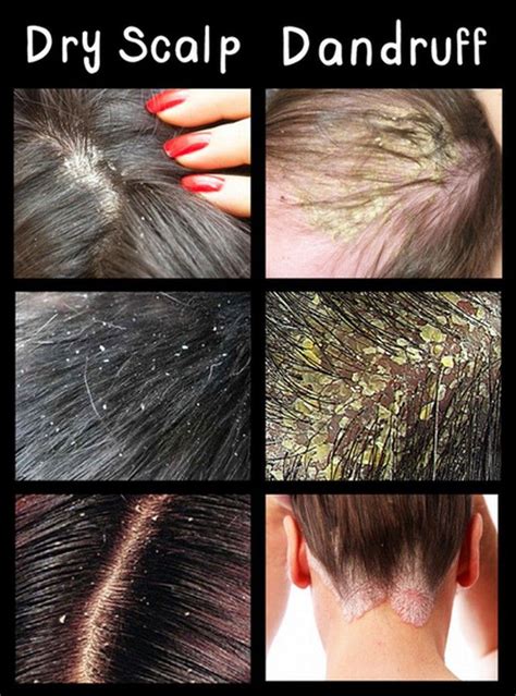 Dandruff in Different Seasons: Adjusting Your Scalp Care Routine Accordingly