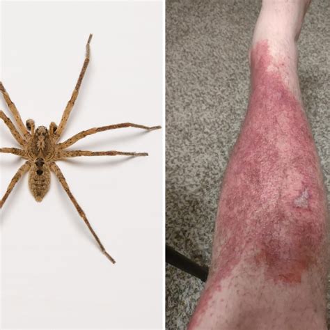 Dangerous Encounters: Bites and Symptoms from the Brown Recluse Spider