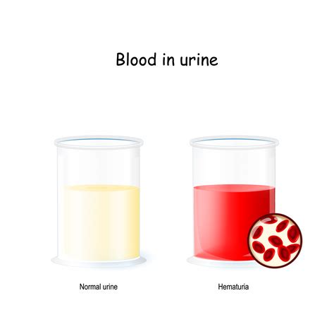 Dark Urine and Hematuria: Blood in the Urine