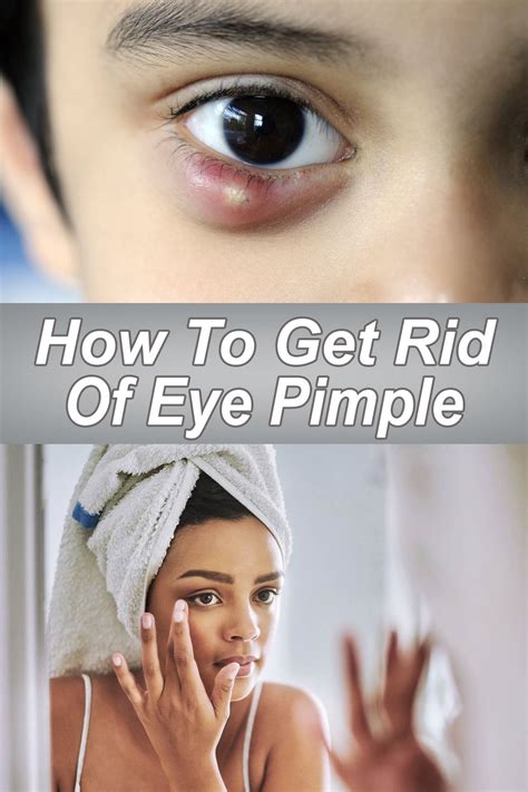 Dealing with Bumps on the Eye: Managing Eye Pimples in Real Life and in Dreams