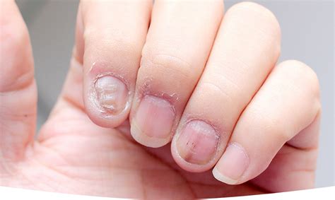 Dealing with Common Nail Issues: Proper Care and Strategies for Treatment