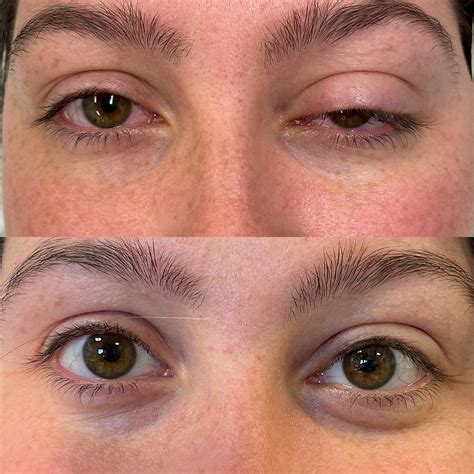 Dealing with Eyelid Drooping and Ptosis: Identifying Causes and Available Treatment Options