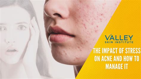 Dealing with Stress and Its Impact on Acne