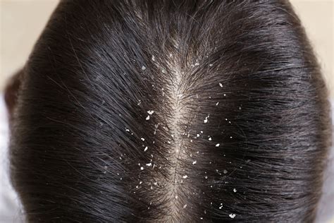 Debunking Dandruff Myths: What Really Works?