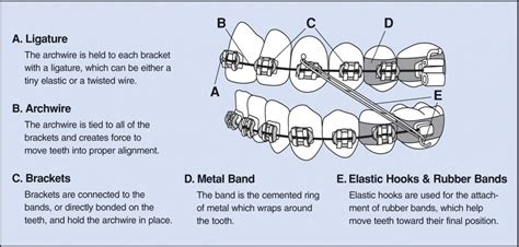 Deciphering the Hidden Meanings Encoded within Dental Orthodontic Apparatus in Fantasies