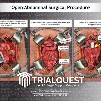 Deciphering the Veiled Significances in Dreams Involving Abdominal Medical Procedures