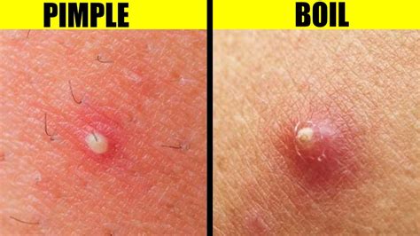 Decoding Different Types of Boils: Exploring Various Forms, from tiny protuberances to enlarged wounds