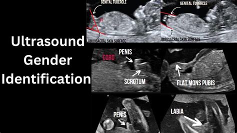 Decoding the Findings: Precision and Boundaries of Gender Ultrasound