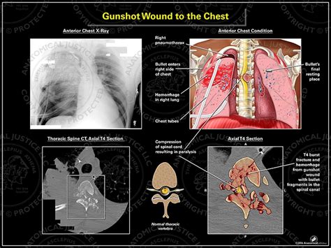 Decoding the Hopeful Message in Dreams Depicting Gunshot Injuries