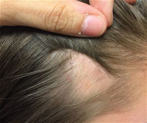 Decoding the Meaning Behind a Hairless Spot on Your Scalp