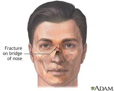 Decoding the Meaning of a Fractured Nasal Bridge Dream within the Scope of Personal Connections