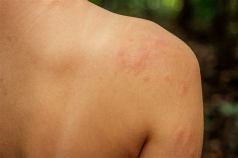 Decoding the Significance of Itchy Bug Bites in Reveries