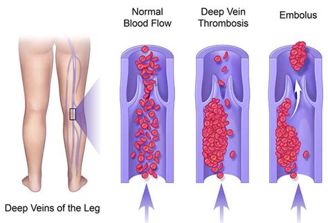 Decoding the Subconscious: Understanding the Significance of Blood Clots in the Lower Extremities