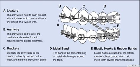 Decoding the Symbolism of Orthodontic Appliances