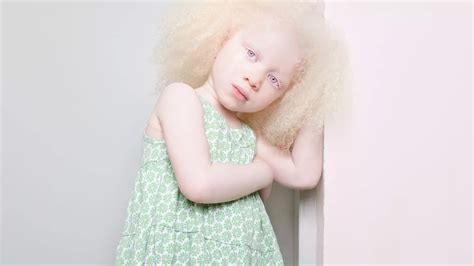 Delving into Albinism: Exploring the Science and Symbolism Behind the Condition