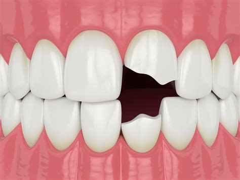 Dental Health and Fractured Teeth