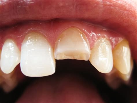 Dental Trauma: Understanding the Factors Behind a Fractured Tooth