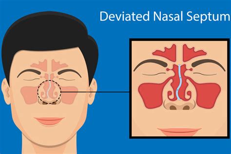 Deviated Septum: A Structural Issue