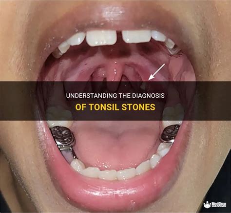 Diagnosing Tonsil Calculi: Recognizing the Indicators