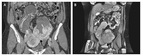 Diagnosing and Managing Pregnancy in the Abdominal Cavity