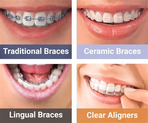 Different Options for Orthodontic Braces