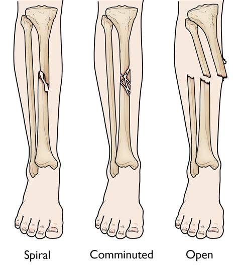 Different Types of Shin Fractures