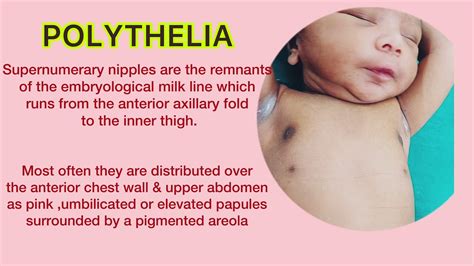 Differentiating Between Third Nipple and Polythelia: What's the Difference?