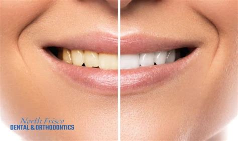 Discover the Advantages of Professional Teeth Whitening