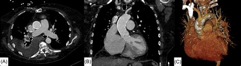 Discovering Coral Aorta's Future Plans