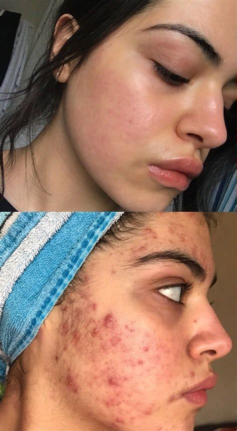 Discovering Effective Approaches to Treating Severe Acne