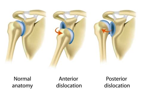 Dreaming of Dislocated Shoulders: Exploring the Anxiety of Losing Control