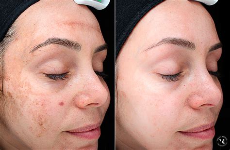 Dreaming of Flawless Skin? A Face Peel might be the Solution