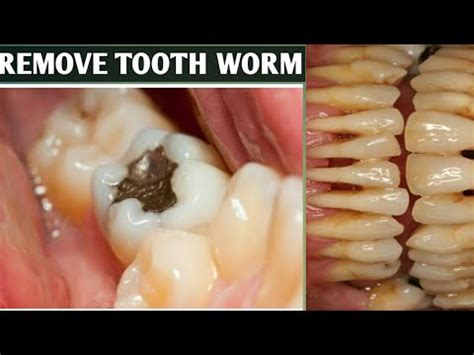 Dreaming of Toothworms: Myth or Reality?