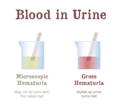 Dreams of Hematuria: Understanding the Presence of Blood in Urine during the Journey of Expecting a Child