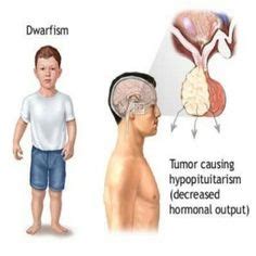 Dwarfism: Understanding the Basics