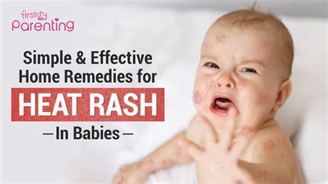 Easing Baby's Discomfort: Natural Remedies for Infant Skin Irritation