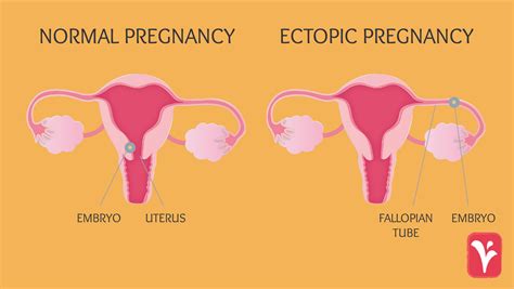 Ectopic Pregnancy