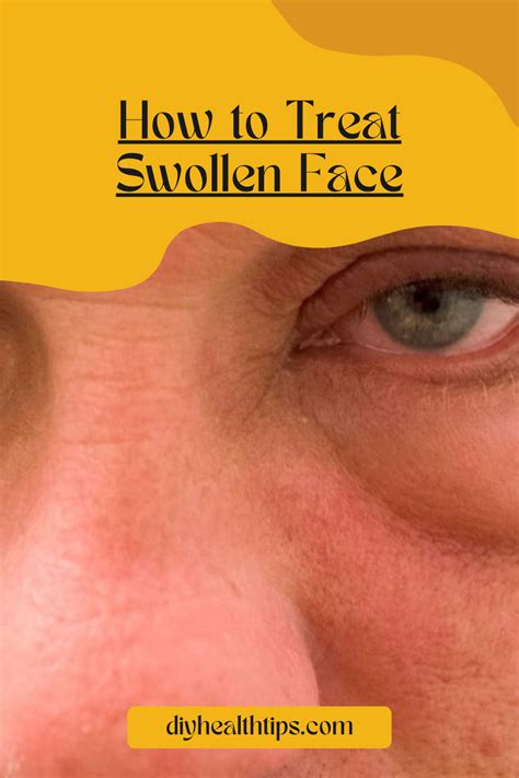 Effective Home Remedies for Alleviating Swollen Facial Cheeks