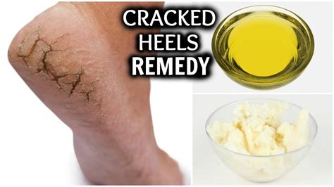 Effective Home Remedies to Heal and Prevent Flaky Skin on Feet