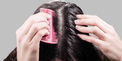 Effective Remedies for Controlling Excessive Dandruff