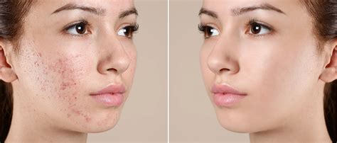 Effective Skincare Tips for Blemish-Prone Complexion