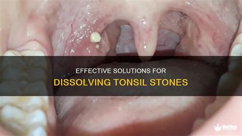 Effective Solutions and Remedies for Dealing with Tonsil Stones